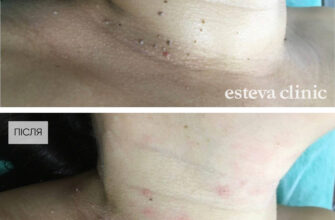 Наслідки після видалення папілом: що очікувати після процедури